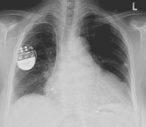 Pacemaker X-ray