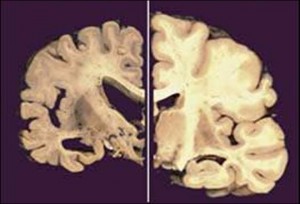 Alzheimer's brain, Alzheimer's, Brain picture, damaged brain, memory loss, human brain, brain scan