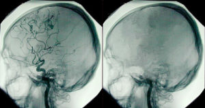 Side by side images of brains; one healthy one dead