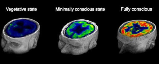 Scans of the brain show different levels of consciousness