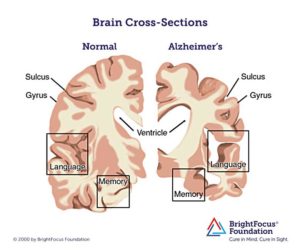 An Alzheimer's affected brain versus a normal brain