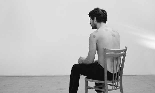 From The Unforgetting, Peter Watkins sits on hair with bruises on his upper body made from Chinese cupping therapy