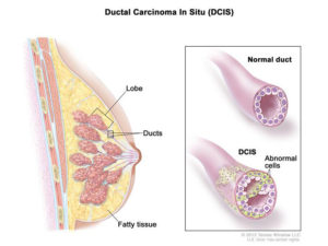 Drawing of DCIS the cancer most often detected by mammograms