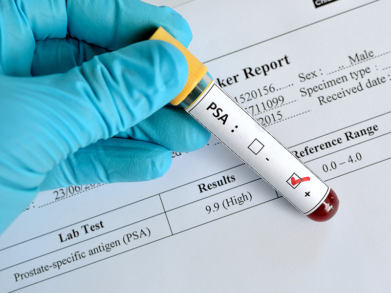 Tube of blood labeled for PSA screening test