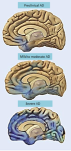 An illustration of the stages of Alzheimer's on the brain, with brain matter slowly deteriorating over time