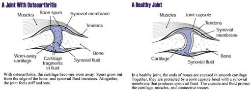 drawing of healthy joint and joint with osteoarthritis