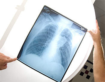 Doctor reading Xray for prognosis