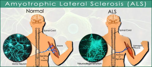 Illustration of normal nerve and muscle vs. muscles and nerves affected by ALS