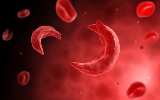 Sickle cell disease causes abnormally shaped red blood cells shown here