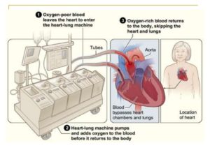 heart lung machine used in heart surgery