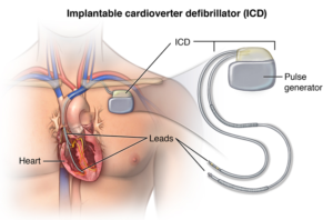 ICD device helps restart the heart of patients with heart disase