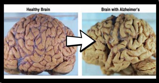 Complete a dementia specific advance directive