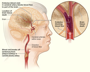 Diagram of a stroke due to too many low-calorie sweetened beverages 