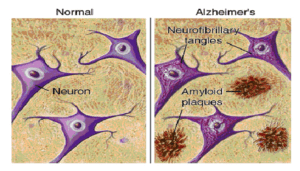 Graphic showing difference in amyloid beta build up between a normal brain and one with Alzheimer's disease.