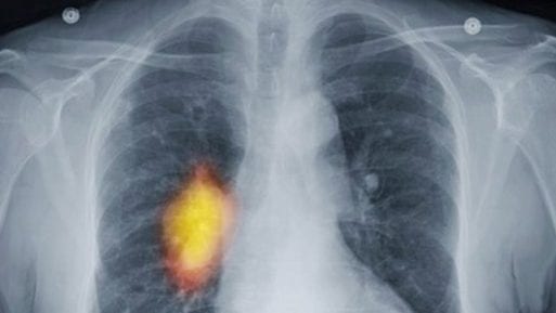 Lungs showing a lung cancer that might respond to early palliative care
