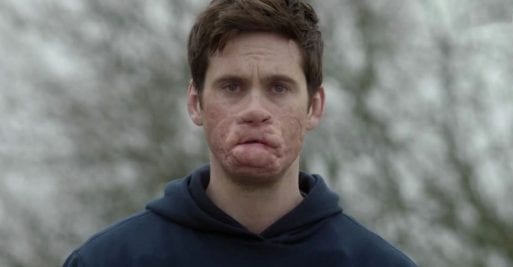 Tom Riley with a facial disfigurement due to sepsis in the movie "Starfish."