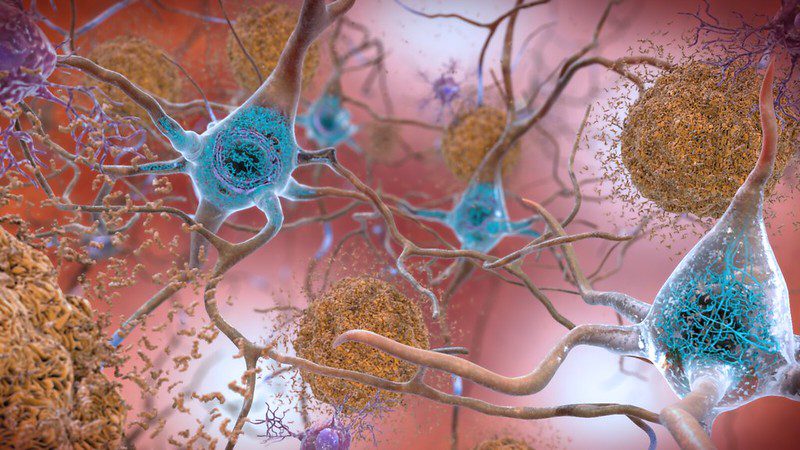 beta amyloid affecting brain cells in Alzheimer's disease