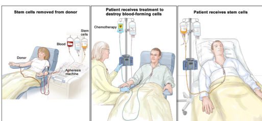 stem cell transplant graphic